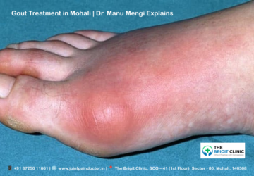 Gout Treatment in Mohali | Dr. Manu Mengi Explains